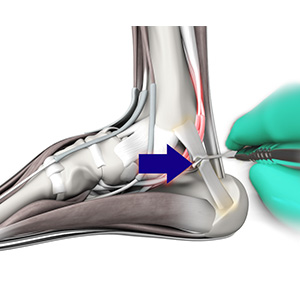 Tarsal tunnel syndrome