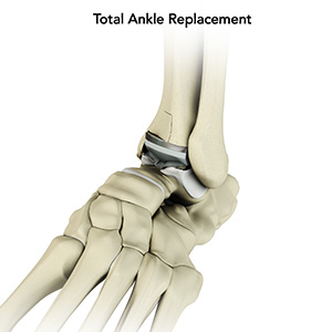 Total Ankle Replacement