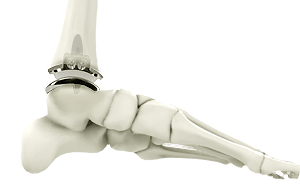 Ankle Replacement vs Ankle Fusion
