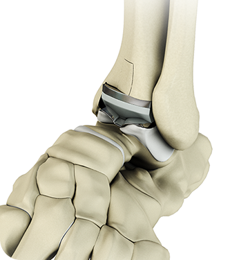 Total Ankle Replacement Implant