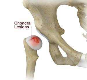 Chondral Lesions or Injuries of the Hip