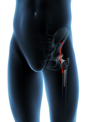 Direct Anterior Hip Replacement