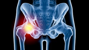 Hip Injury