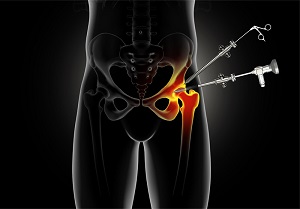 Hip Surgery