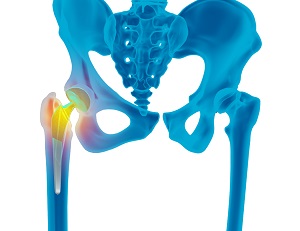Revision Hip Surgery