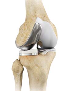 Unicompartmental Partial Knee Replacement
