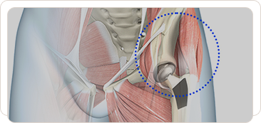 Publications Acetabular Cup Img