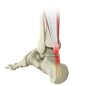 Achilles Tendon Rupture - Educational Picture