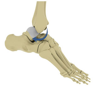 Ankle Dislocation - Educational Picture