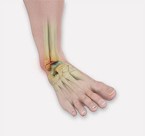 Ankle Fracture Surgery - Educational Picture