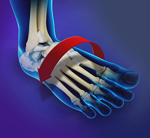 Ankle Instability Surgery - Educational Picture