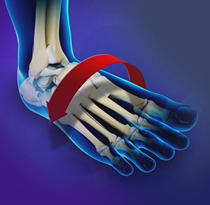 Ankle Instability - Educational Picture