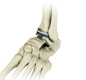 Ankle Joint Replacement - Educational Picture