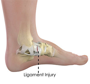 Ankle Ligament Injury - Educational Picture
