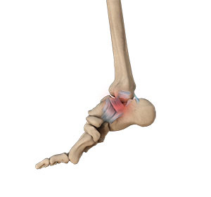 Ankle Sprain - Educational Picture