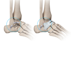 Ankle Stabilization - Educational Picture