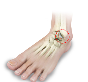 Arthritis - Educational Picture