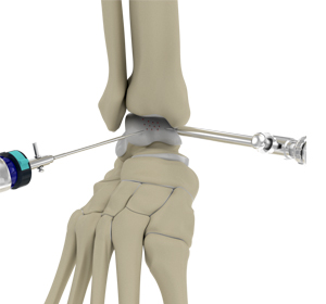 Arthroscopic Ankle Joint Cartilage Repair - Educational Picture