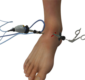 Arthroscopic Surgery - Educational Picture