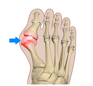Bunion - Educational Picture