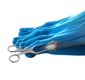 Bunionette Surgery - Educational Picture