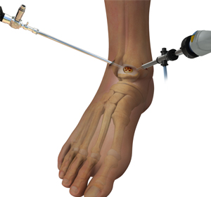 Cartilage Restoration - Educational Picture