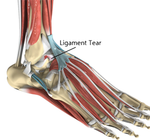 Chronic Lateral Ankle Pain - Educational Picture