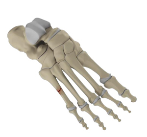 Fifth Metatarsal Fractures - Educational Picture