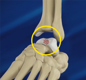 Foot and Ankle Cartilage Repair - Educational Picture