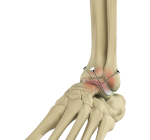 Foot and Ankle Surgery - Educational Picture