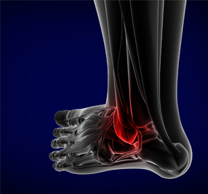 Foot and Ankle Trauma - Educational Picture