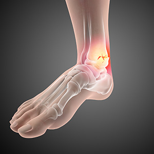 Foot Fracture - Educational Picture