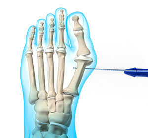 Foot Reconstruction - Educational Picture