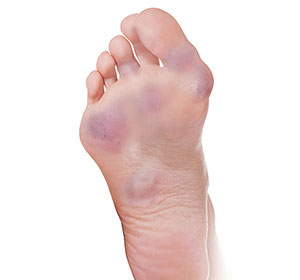 Foot Rheumatoid Arthritis - Educational Picture