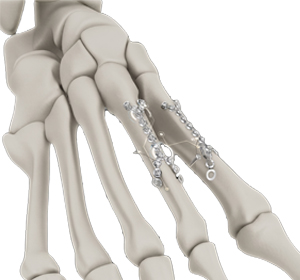 Fracture Repair - Educational Picture