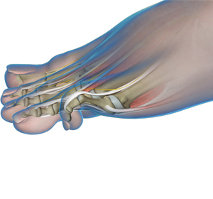 Hammertoe Surgery - Educational Picture