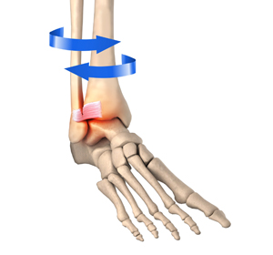 Ligament Injuries - Educational Picture