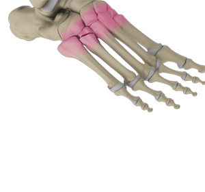 Lisfranc (Midfoot) Injury - Educational Picture
