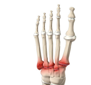 Midfoot Arthritis - Educational Picture