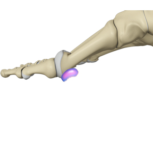 Midfoot Bursitis - Educational Picture