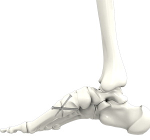 Midfoot Fusion - Educational Picture