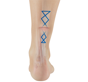 Minimally Invasive Achilles Repair - Educational Picture