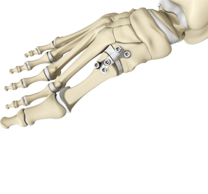 Minimally Invasive Foot and Ankle Reconstruction - Educational Picture