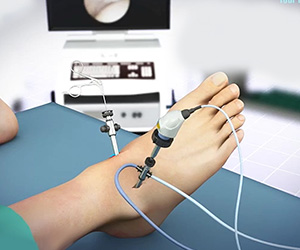 Minimally Invasive Foot Surgery - Educational Picture