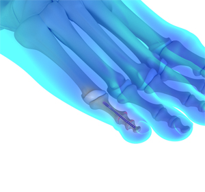 MIS Hammertoe Surgery - Educational Picture