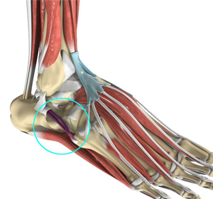 Peroneal Tendonitis - Educational Picture