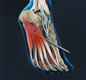 Plantar Fascia Release - Educational Picture