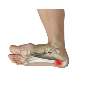 Plantar Fasciitis - Educational Picture
