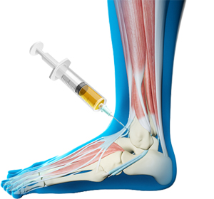 Platelet-Rich Plasma (PRP) for the Ankle - Educational Picture