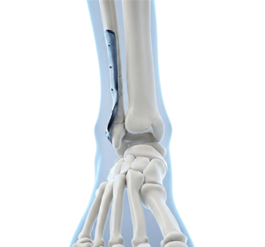 Post-Traumatic Reconstruction of the Foot and Ankle - Educational Picture